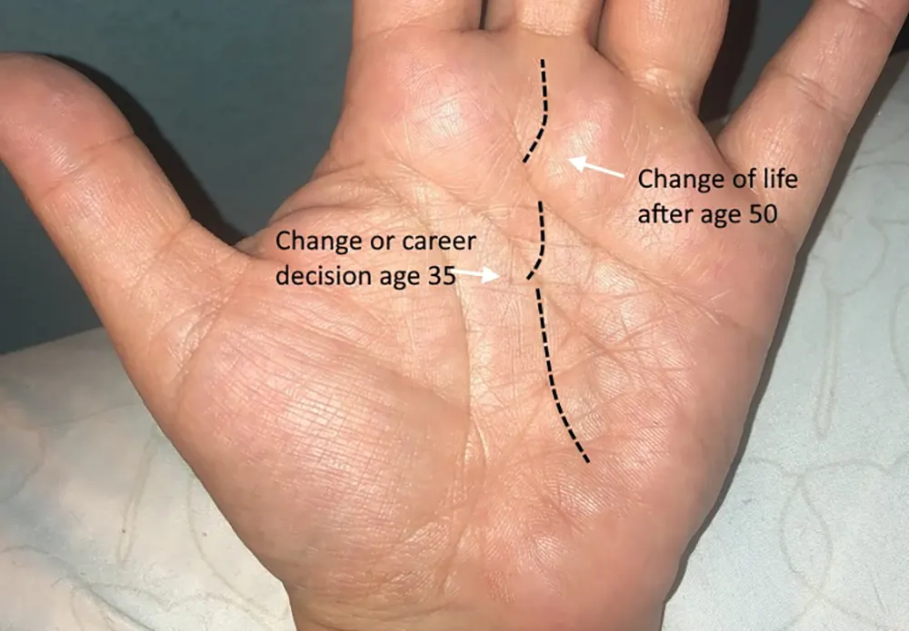 Crosses, Stars, and Breaks on the Fate Line in Palmistry 5 Example of breaks on fate line in palmistry showing interruptions in destiny
